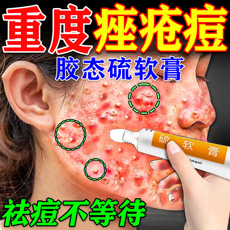 胶态硫软膏专业祛痘杀菌外用软膏国药监局准字痤疮重度暗疮药膏