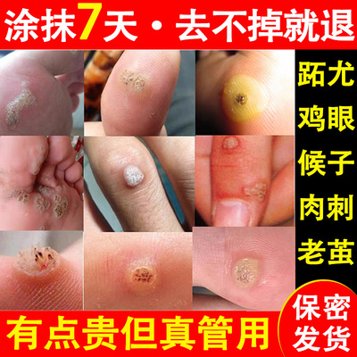 足底跖疣专用膏手上老茧去除病毒疣连根拔根脚底肉刺鸡眼贴鸡眼膏
