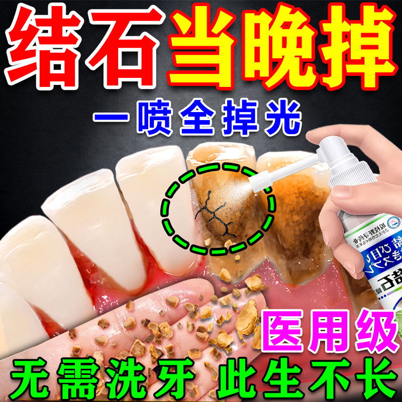 【去除牙结石】专用喷雾剂