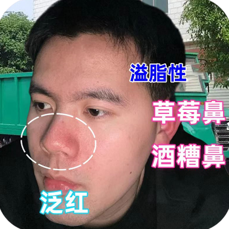 脖子红肿长脓包痘痘鼻翼两次泛红干燥起皮溢脂性脱皮酒糟鼻草莓鼻