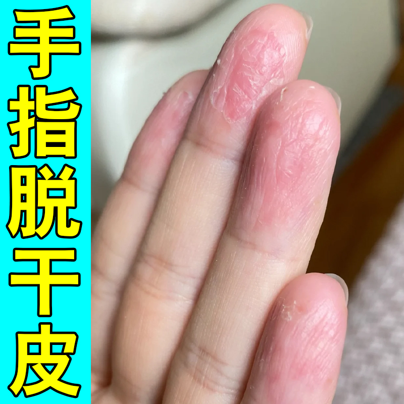 手指脱干皮秋冬换季手干燥粗糙痒手指尖指腹脱皮掉皮起死皮硬皮膏
