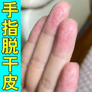 手指脱干皮秋冬换季手干燥粗糙痒手指尖指腹脱皮掉皮起死皮硬皮膏