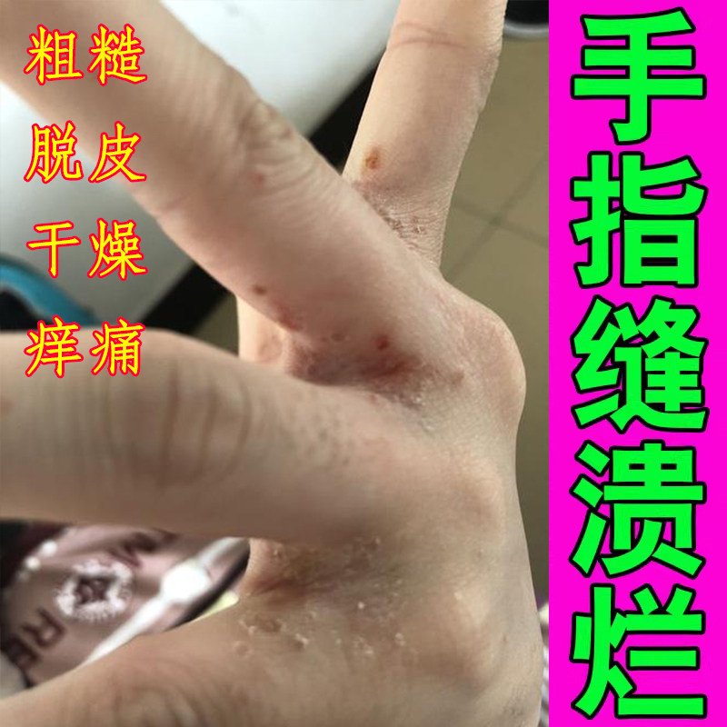 手指缝溃烂药乳膏手指缝脱皮开裂又痛又痒手汗多手气真菌感染专用