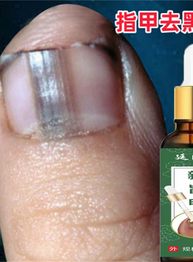 指甲黑色竖纹黑线手指甲真菌感染指甲盖手指甲修复护理手指有竖纹