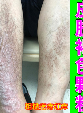 皮肤斑块粗糙发硬起皮色素沉着暗沉角质增厚纹理杂乱肌肤干燥起皮