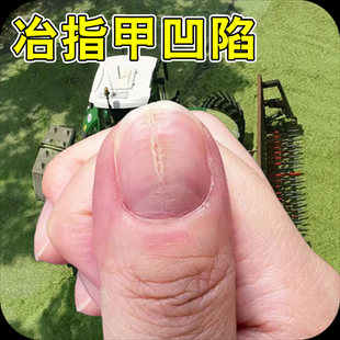手指甲裂缝指甲表面竖纹凹凸不平指甲盖裂开手指甲坏甲药