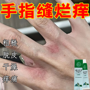 手指缝溃烂药乳烂手丫专用膏手指间经常碰水干痒开裂发红脱皮分离