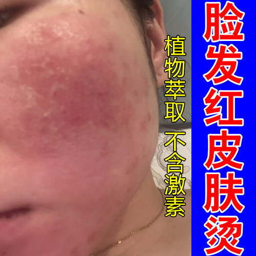 脸发红皮肤烫敏感肌去红血丝脸部粗糙干燥屏障受损增厚角质层修复