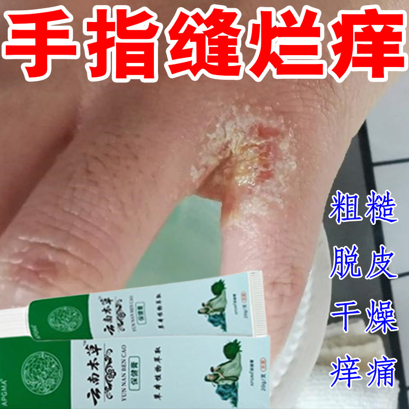 烂手丫专用乳药手指缝溃烂膏手气去痒脱皮杀菌干痒手痒膏真菌感染