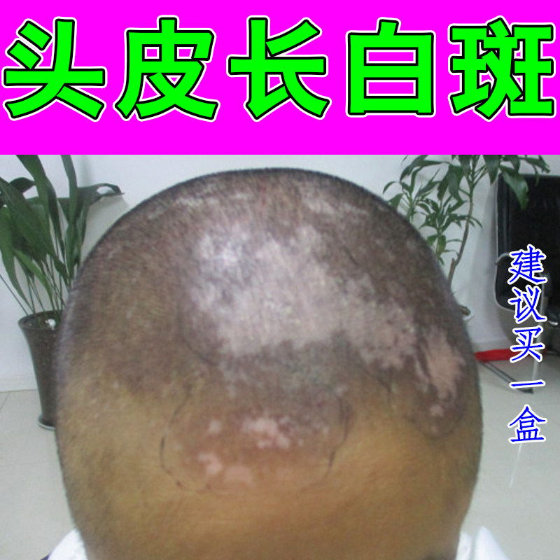 头顶鬓角发际浅白片块头皮起皮脱屑细碎白屑耳后脖颈零星白点斑块