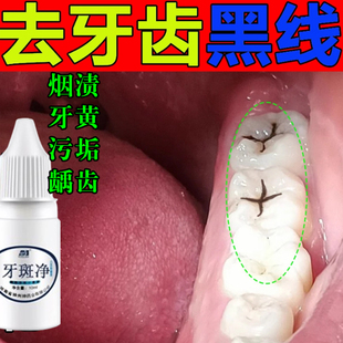 氟斑牙四环素牙专用牙膏黄烟渍速效治牙齿黑线牙菌斑净牙神器