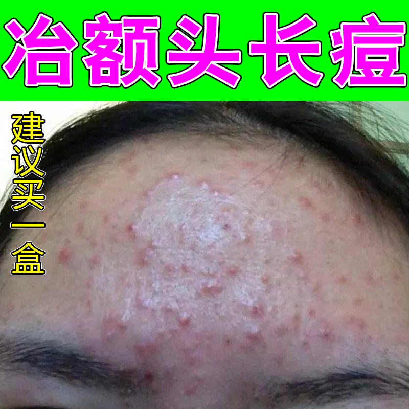 冶额头长痘脸上起红疙瘩痘痘下巴红肿脓包痘闭口粉刺脸颊两侧颗粒