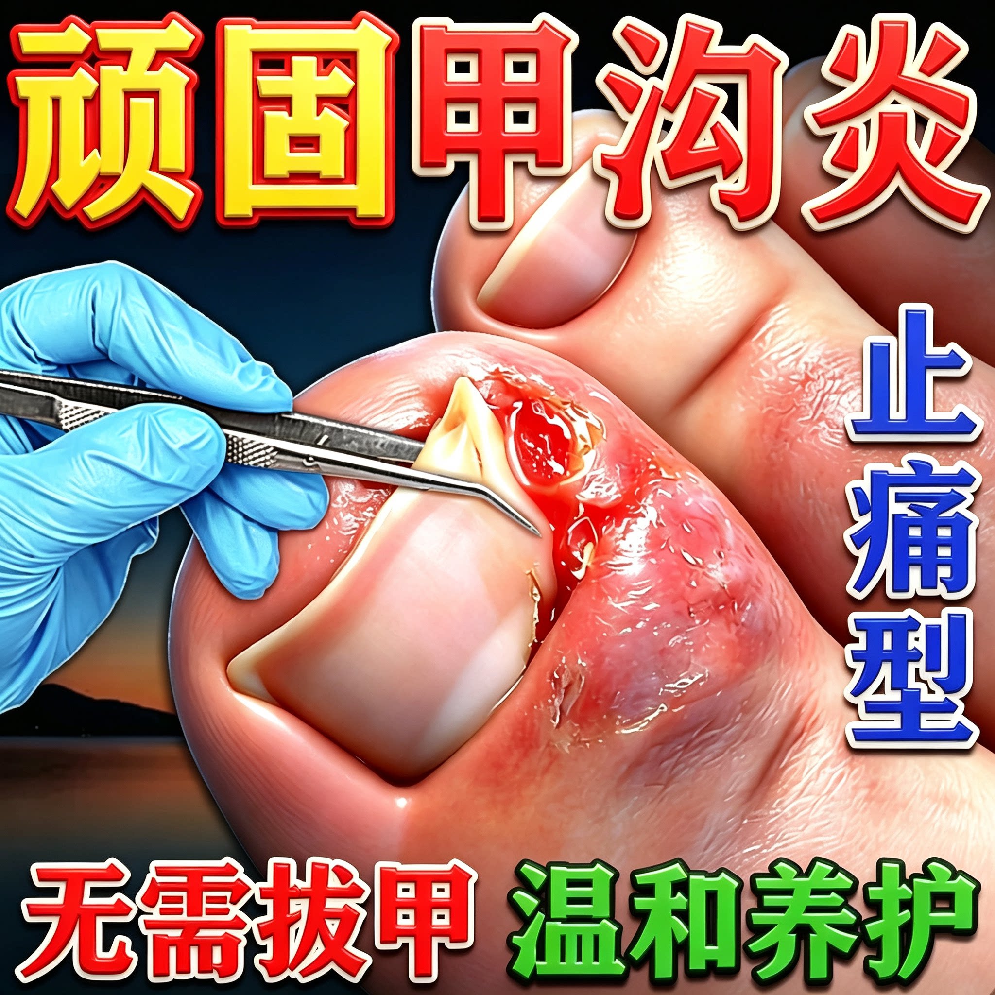 甲沟炎治疗专用非效特药息肉去除嵌甲克星脱指甲刀液软化剂勾
