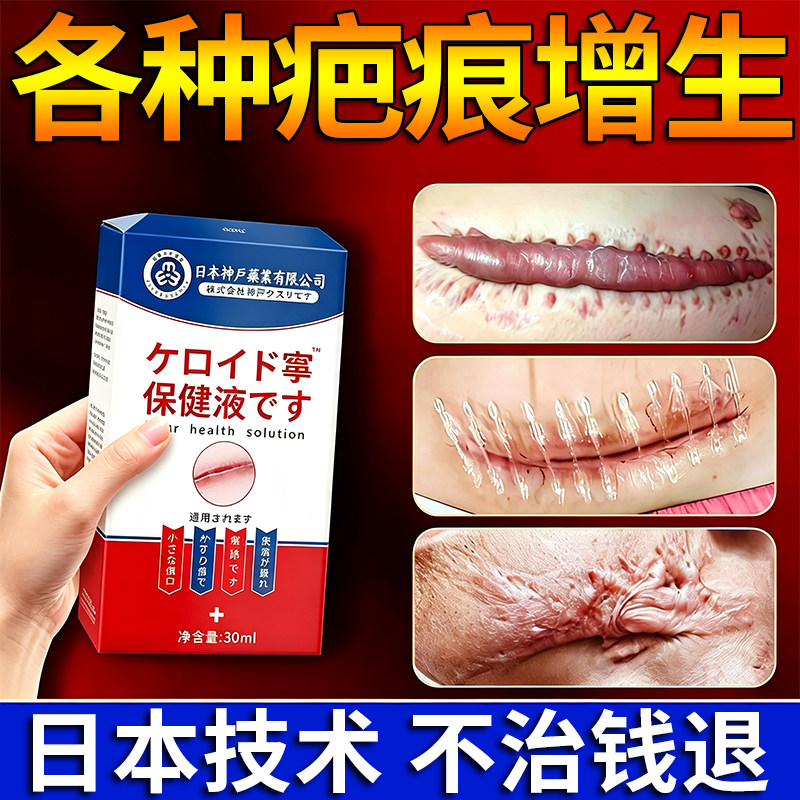 日本去除增生疤痕疙瘩凸起软化胸前瘢痕体质伤疤手术疤痕灵修复膏