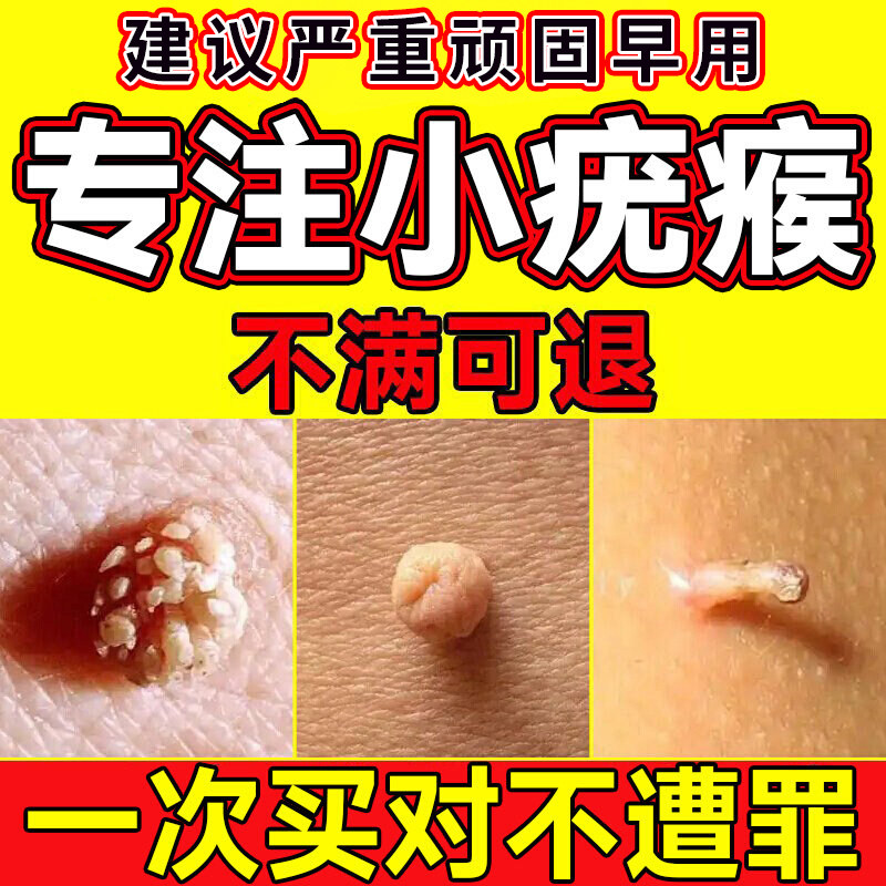 医用疣瘊丝状疣扁平疣去小肉粒脖子腋下皮赘肉粒去除神器正品