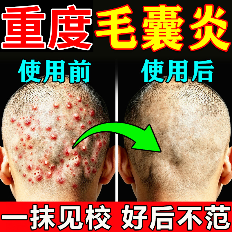 毛囊炎头部头皮痒前胸后背专用背上去除有红疙瘩痘痘膏马拉色菌