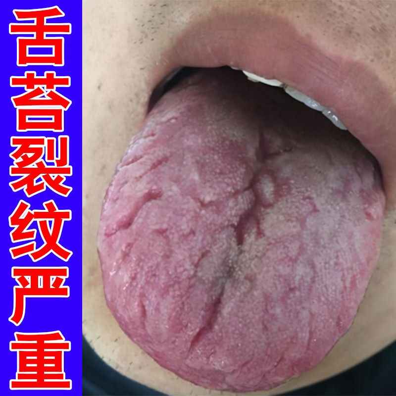 舌苔白厚口干口渴口苦舌头有纹口皮肤消毒护理（消）