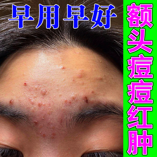 额头长痘痘闭口上火熬夜额头疙瘩脸上起小疙瘩闭口粉刺脸部额头痘