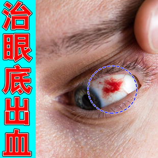 眼底出血眼药水治眼睛充血结膜炎红血丝修复去黄斑视线模糊眼药水