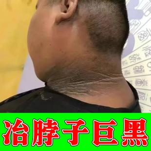 脖子黑沉淀颈部脖子黑后面黑棘皮病修护皮肤晒黑草木膏