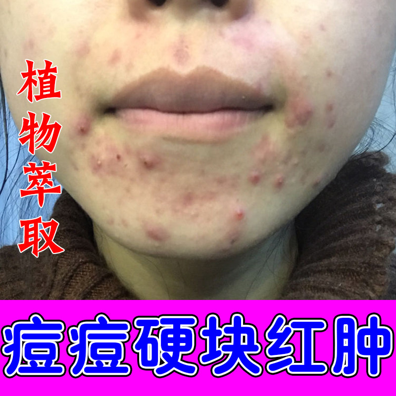 闭口粉刺上火红肿硬块起脓包下巴反复长痘痘小颗粒疙瘩冒白尖膏