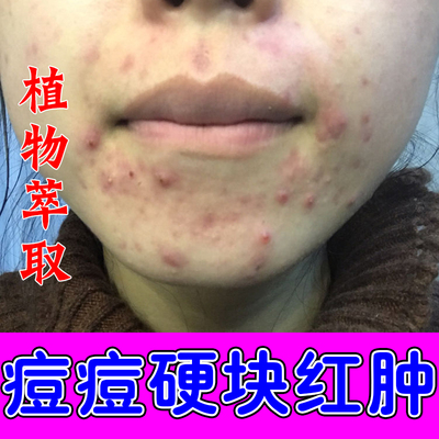 闭口粉刺上火红肿硬块起脓包下巴反复长痘痘小颗粒疙瘩冒白尖膏