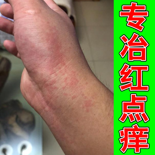 专冶胳膊小红点痒红色肿刺挠手上起小水泡手指起痒感染湿用软膏