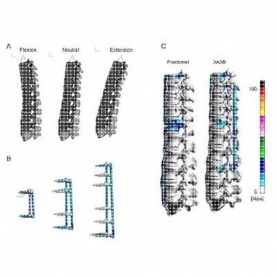 医学有限元分析 生物力学彷真模拟 Ansys Workbench有限元分析。