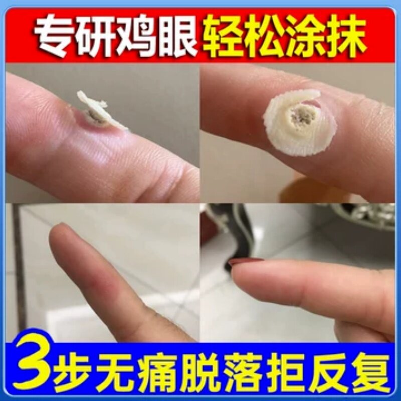 白云山鸡眼贴鸡眼膏药水瘊子手足部去脚底脚趾部跖疣灵老茧根肉刺