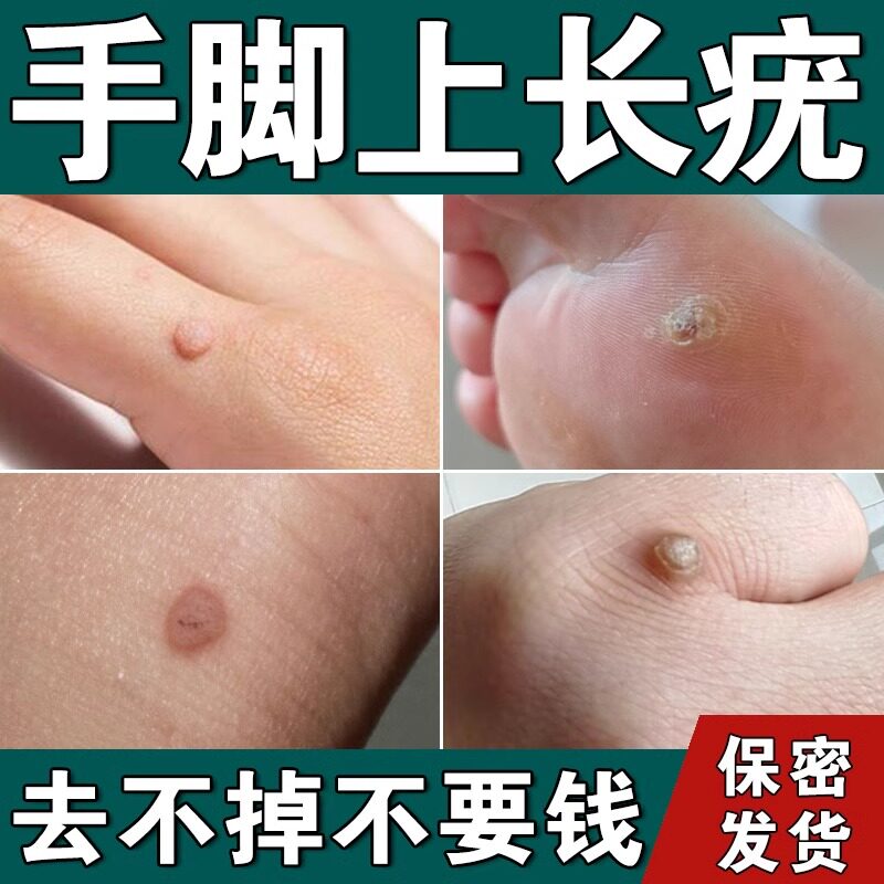 鸡眼跖疣专用膏去除足部脚底寻常疣手脚趾根上长肉刺瘊子祛除神器