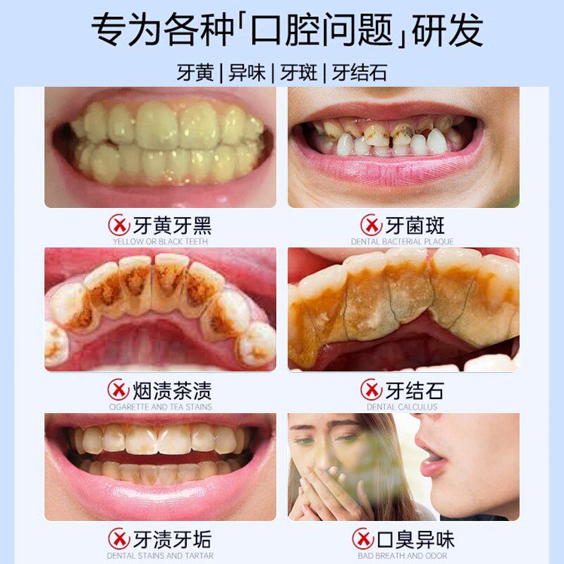 洁牙粉去黄洗白去口臭黄牙齿结石污垢牙渍牙垢清洁非美白神器男女