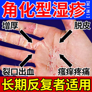 角化型湿疹手癣膏脱皮干裂真菌感染慢性角质化皲裂性手部湿疹脚部