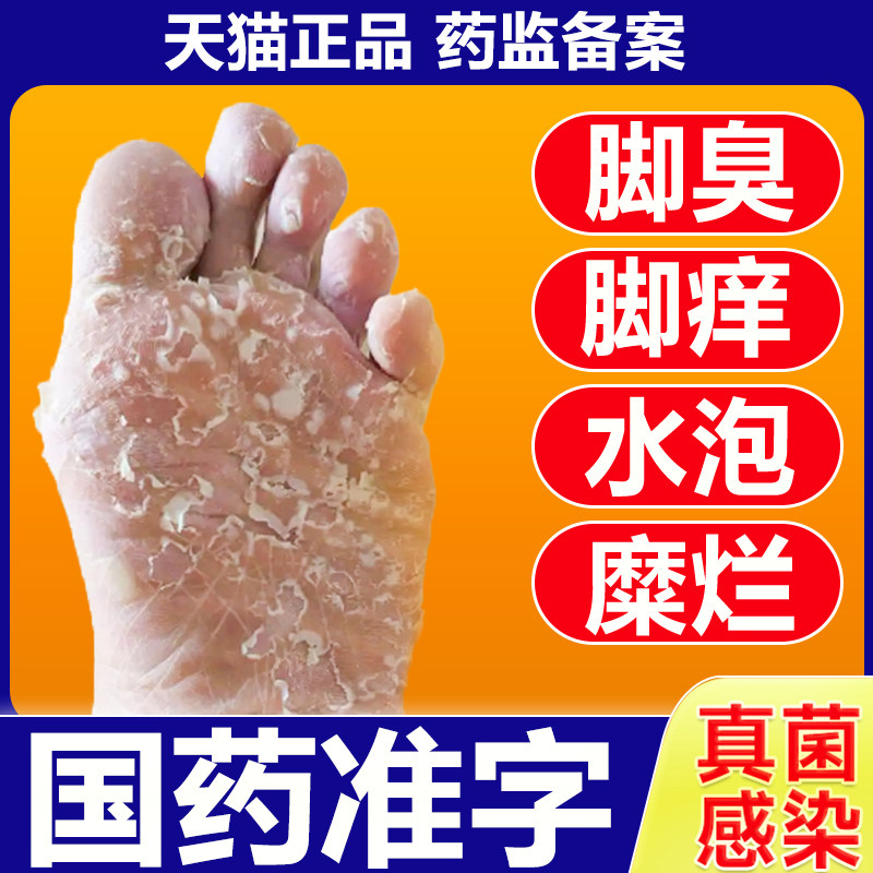 国药准字治脚气喷雾真菌感染药足癣引起烂脚丫水泡脱皮脚趾缝糜烂