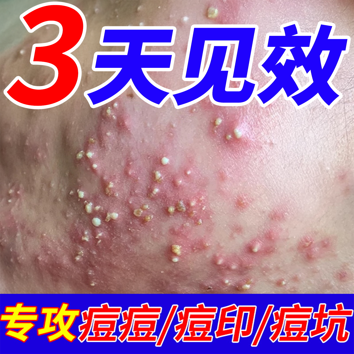 祛痘印修覆淡化痘印祛痘膏痘坑男生女痘消闭口炎粉刺克 克星面霜