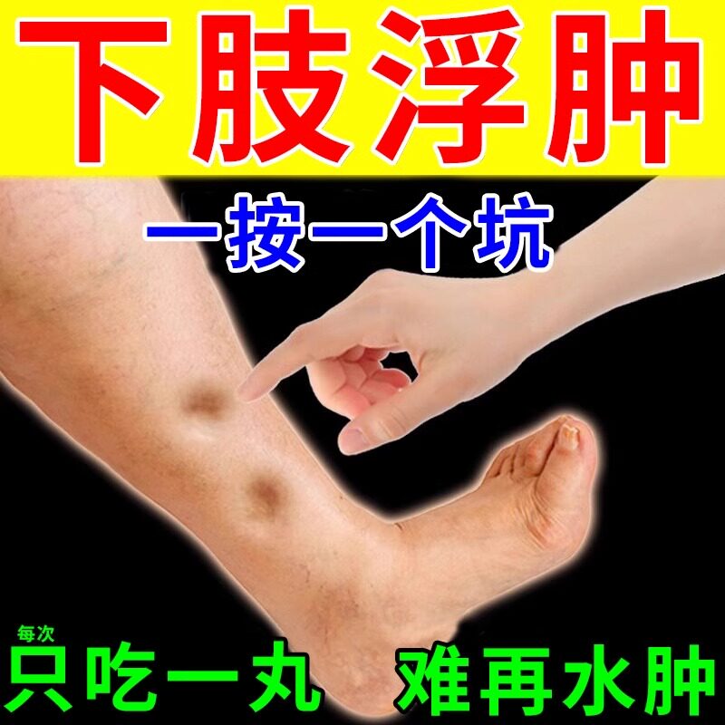 四肢水肿消肿药去老人下肢浮肿小腿水肿脚背消肿专用药补益地黄丸