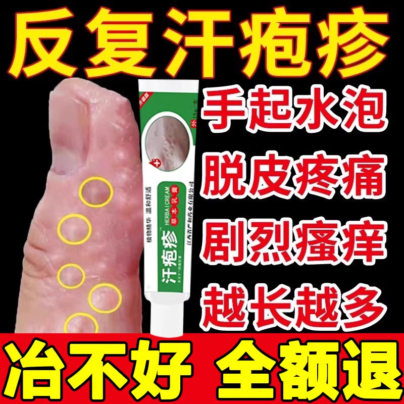 汗泡疱疹药膏手上起小水泡汗状疱疹止痒真菌感染汗泡湿疹用专软膏