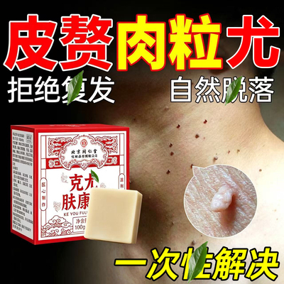 克尤皂肤康皂去疣尤瘊脖子上长小肉粒疙瘩丝状尤疣扁平疣香皂官方