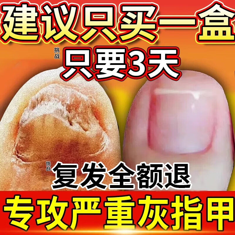 治疗去灰指甲专用药水正品官方旗舰店真菌感染特效第滴一净名xl