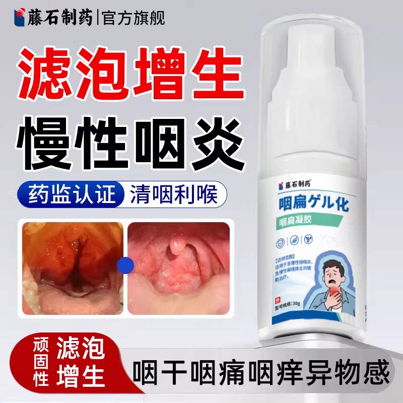 藤石制药滤泡增生慢性咽炎咽喉咽后壁淋巴咽喉炎舌根异物感喷剂SY