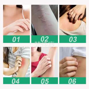 荨寻乳麻过敏配乳膏皮肤外用疹瘙痒草本方RJV奇痒难忍抑菌膏官方