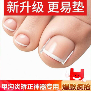 甲沟矫正器炎神器正甲贴指甲贴片嵌甲脚趾甲往肉里长纠正填充垫片