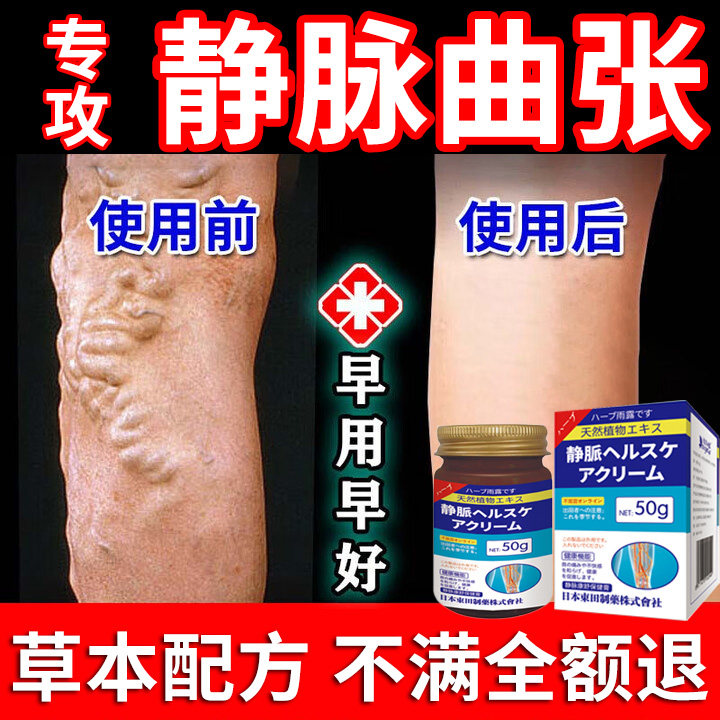 日本医用静脉曲张冷敷凝胶蚯蚓腿膏青筋凸起腿药修覆专用特正品效