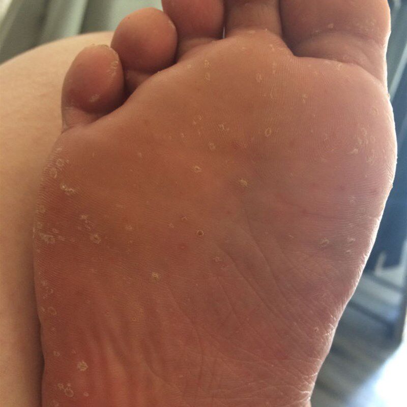 脚底脱皮掉皮起水泡痒脚后跟起干E皮蜕皮长水泡钻心痒脚底起皮烂