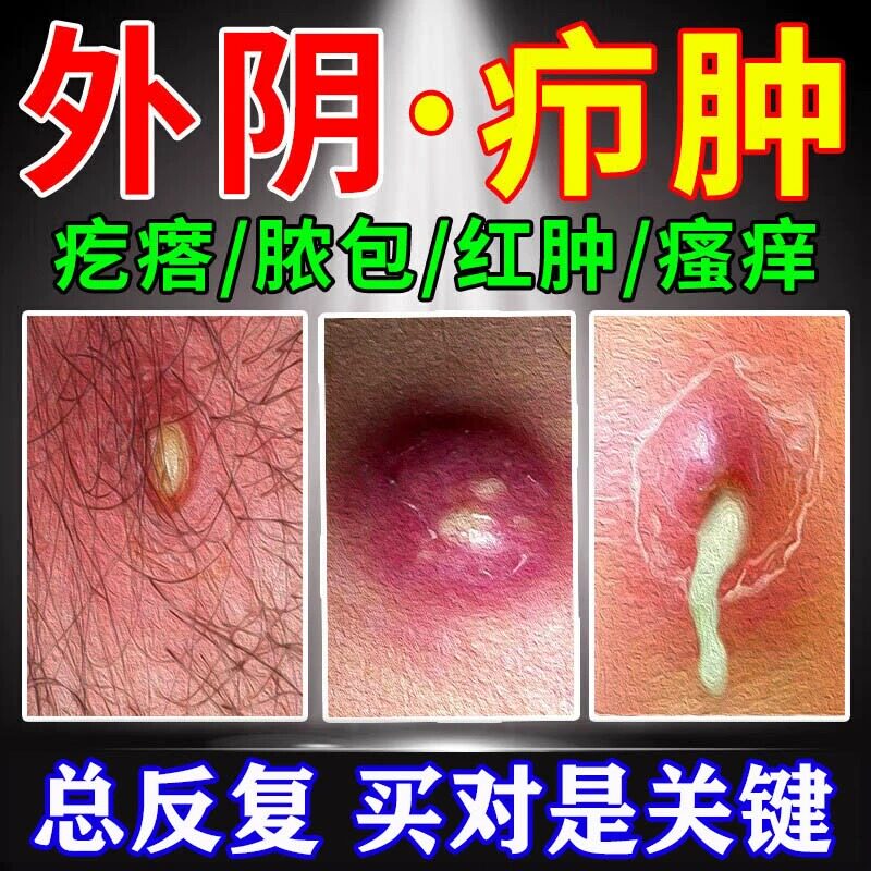外阴疖肿拔毒膏火疖子药膏拔脓膏脓包硬块敷贴屁股上私处长痘痘LL