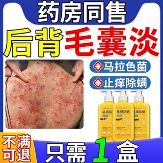 治后背长痘痘毛囊淡疗专用二硫化硒洗剂药膏马拉色菌特效沐浴露FF