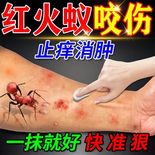 红火蚁叮咬止痒消肿克专用星被蚂蚁咬伤了擦什么药房同款膏外用