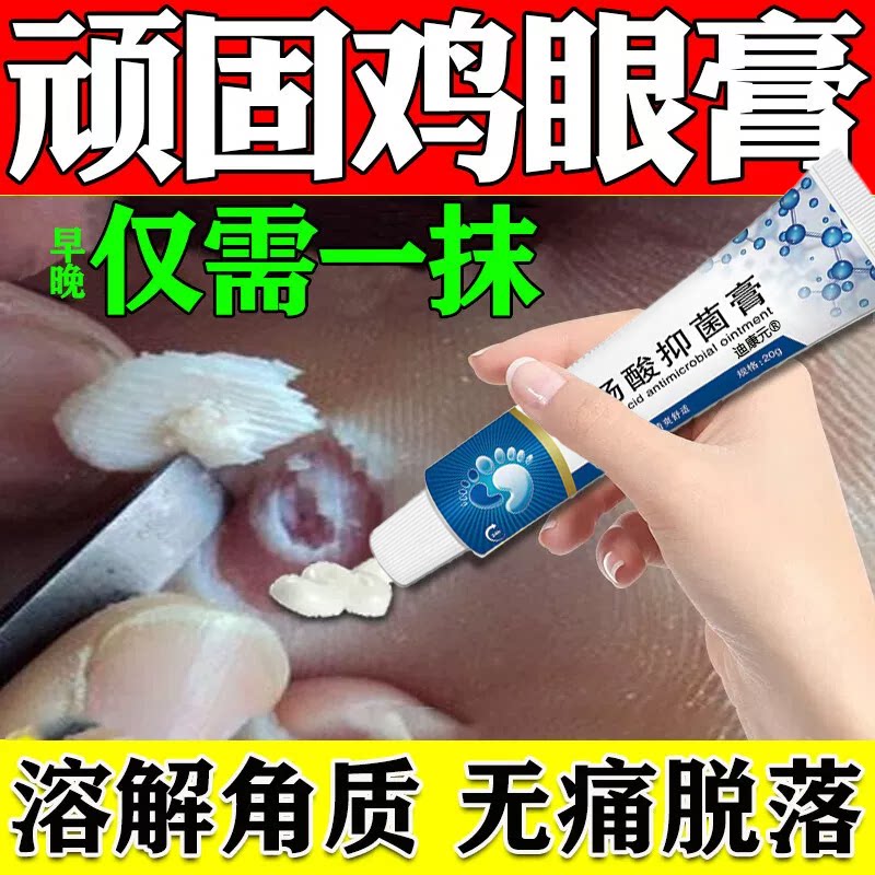 【鸡眼专用膏】一抹无痛秒脱