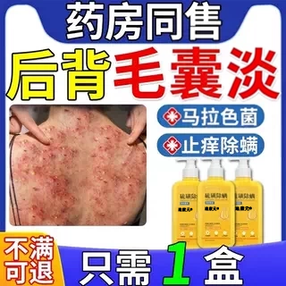 治后背长痘痘毛囊疗炎专用二硫化