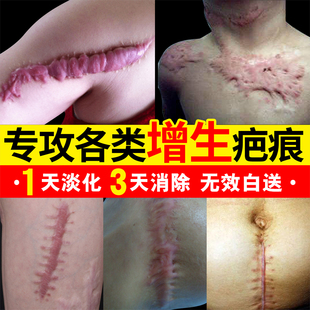 疤克祛疤膏疤痕增生凸起去除疙瘩正品官方旗舰店修复医用硅酮凝胶