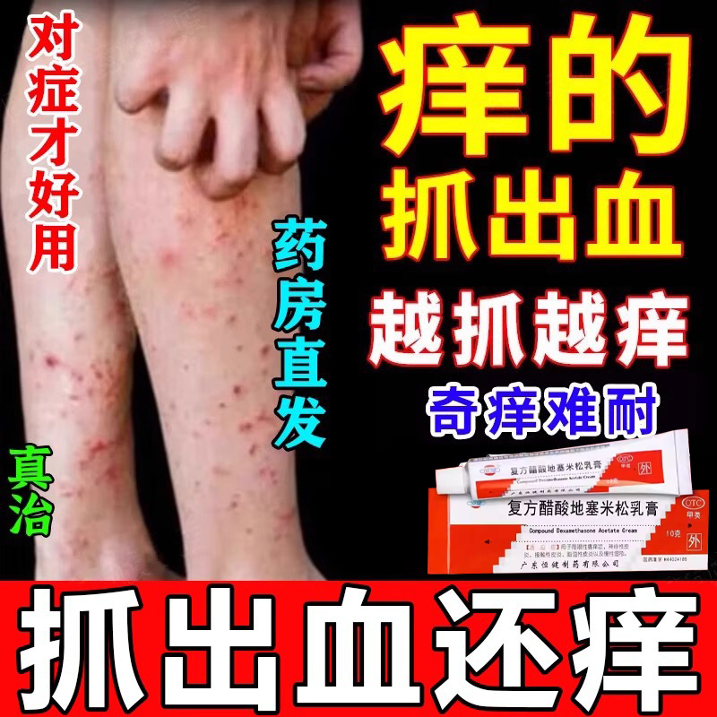 皮肤湿疹止痒专用硬疙瘩皮肤瘙痒皮炎平乳膏